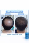 Erkek Saç Serumu, Saç Serumu , Saç Gürleştirici (3 Adet Serum Tarak Hediye )