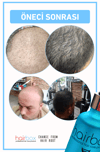 Hairbox Erkek Saç Serumu (3 Adet Serum + Dermoroller Hediye)