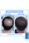 Hairbox Erkek Saç Serumu, (3 Adet Serum + 1 Adet Dermaroller + 1 Adet Şampuan)