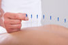 Akupunktur iğnesi
kuru iğne,
Acupuncture needle 0.16*7mm
