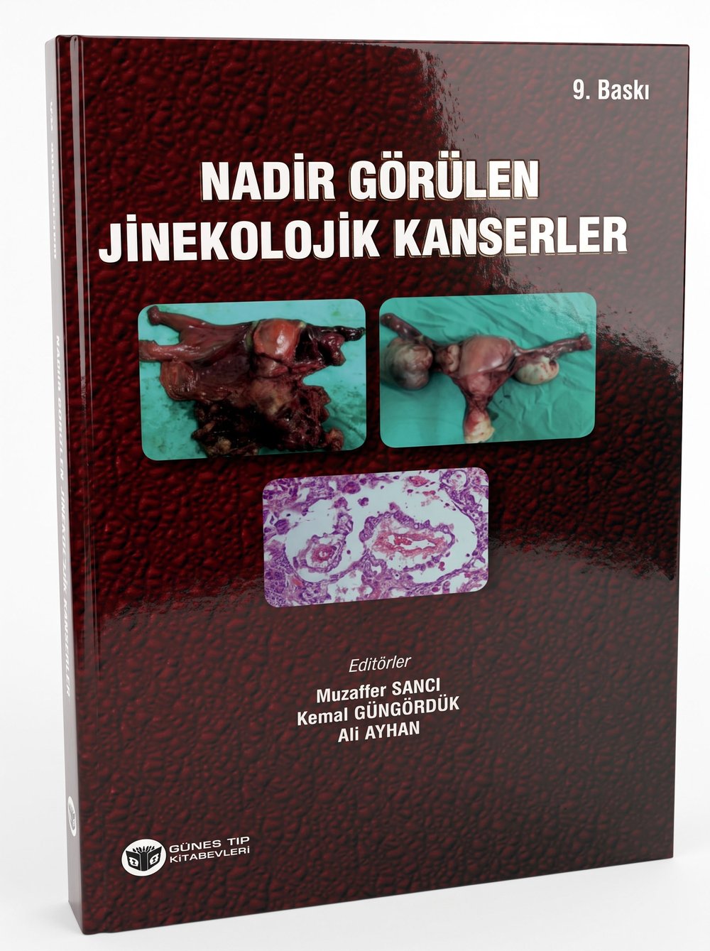 Nadir Görülen Jinekolojik Kanserler