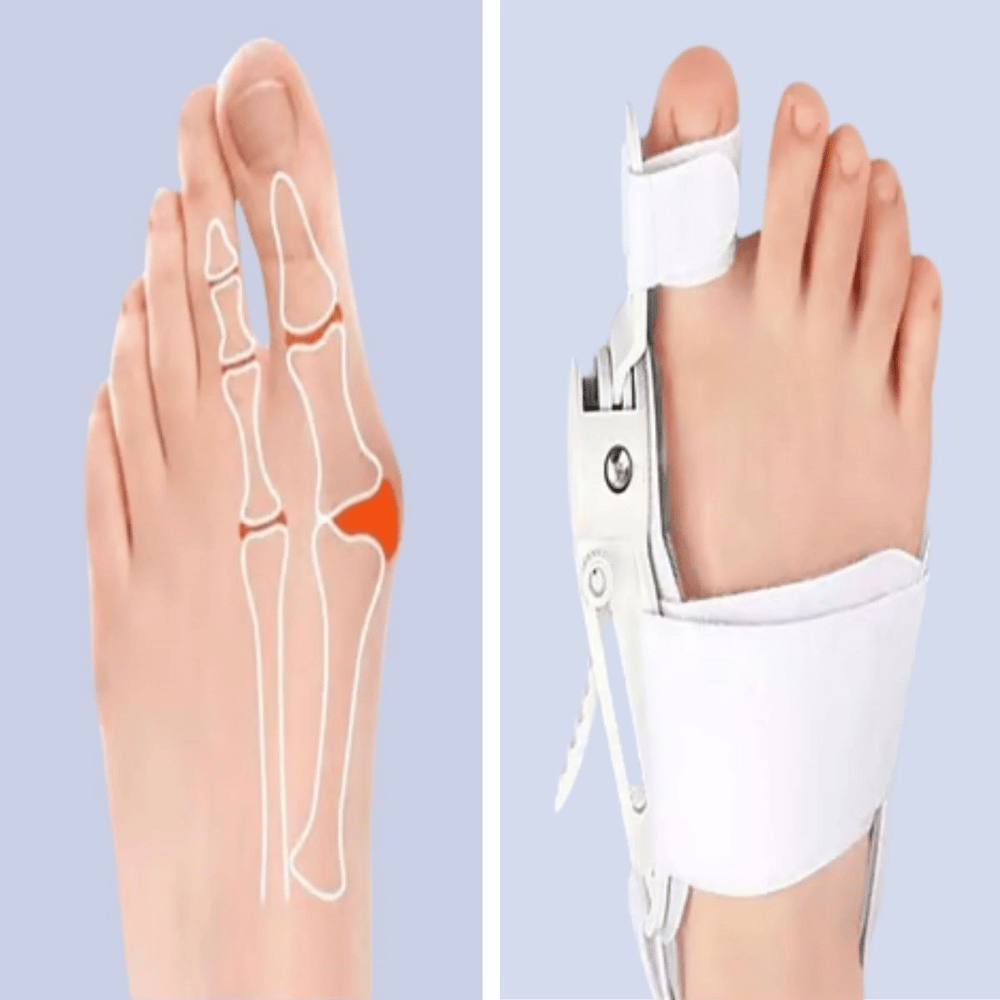 Ayarlanabilir Ayak Baş Parmak Kemik Düzeltici – Halluks Valgus (bunyon) Aparatı, Gece Gündüz Kullanıma Uygun Ayak Düzeltme Ateli Bx40