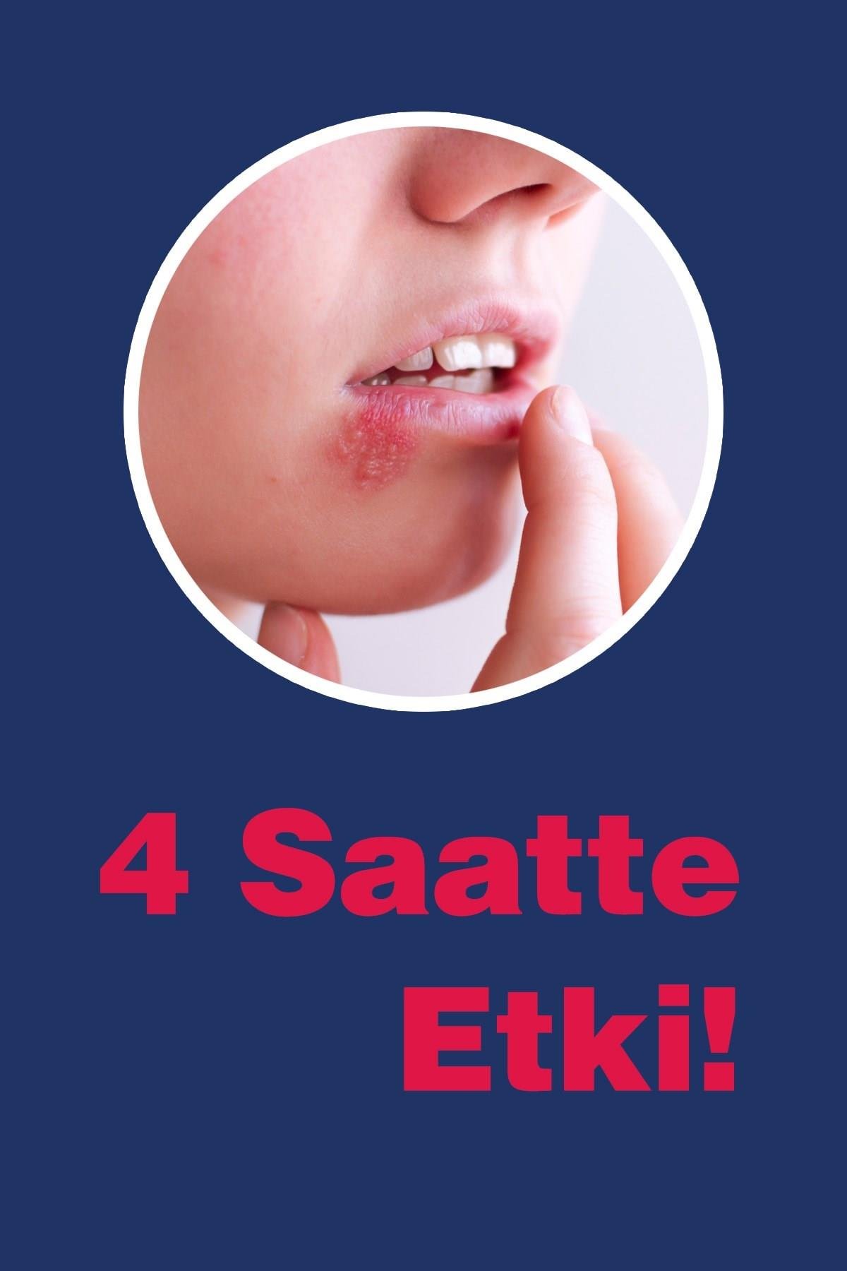 Ux Uçuk Kremi 7 ml 3 ml ( Çay Ağacı Yağı / Tea Tree Oil )