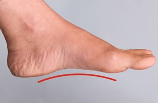 Düz tabanlık belirtileri nelerdir?