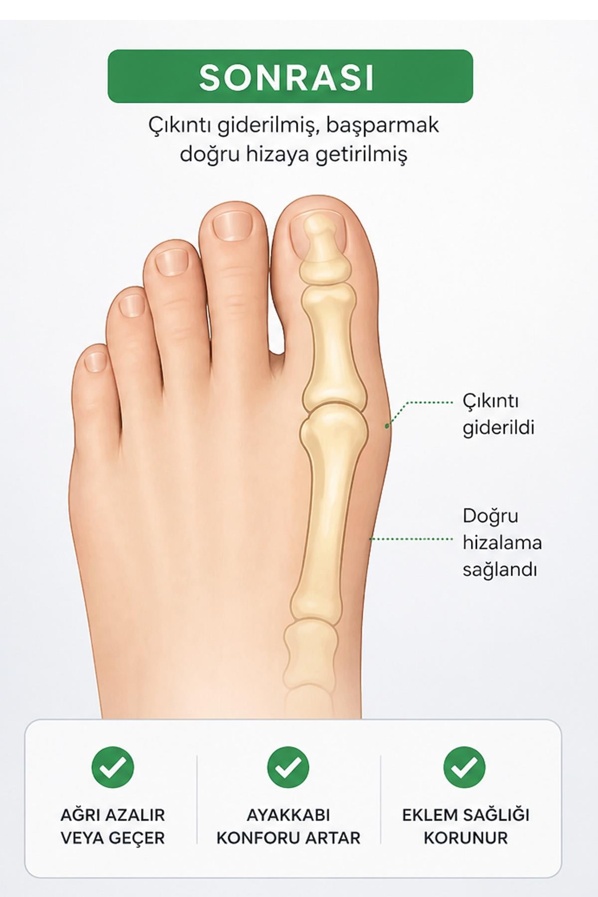 Başparmak Düzeltici Atel Ortopedik Halluks Valgus Aparatı Ayak Kemik Çıkıntı Düzeltici