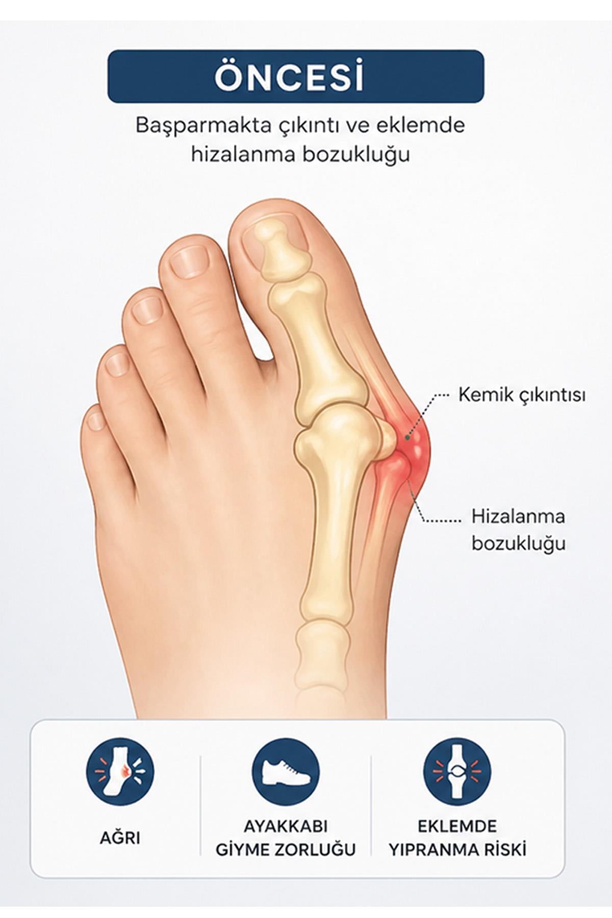 Başparmak Düzeltici Atel Ortopedik Halluks Valgus Aparatı Ayak Kemik Çıkıntı Düzeltici