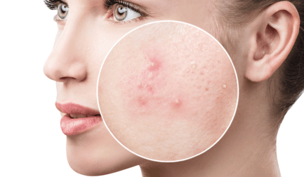 Propionibacterium Acnes!