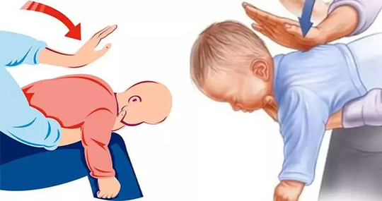 Bebekli Evlerin Kurtarıcısı: Heimlich Manevrası Bebeklerde Nasıl Uygulanır?