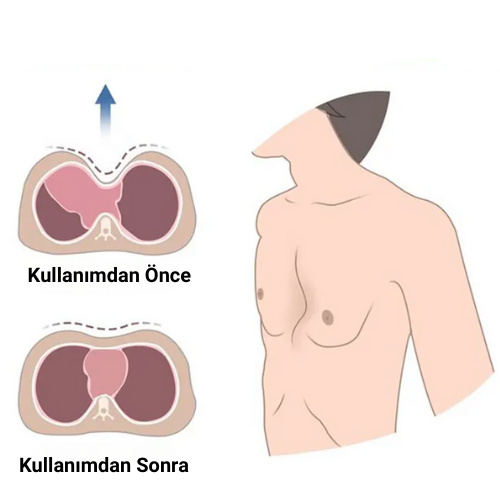 Kunduracı Göğsü Vakum Aleti