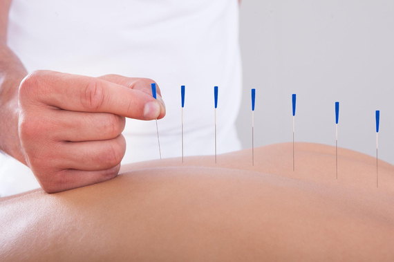 Akupunktur iğnesi
kuru iğne,
Acupuncture needle 0.30*60mm